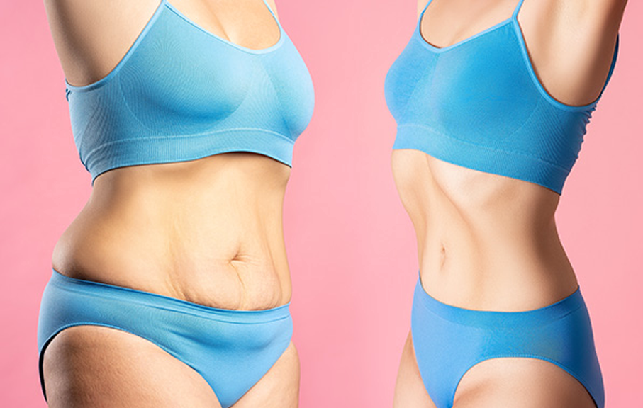 Liposuction & Tummytuck (Body Conturing)