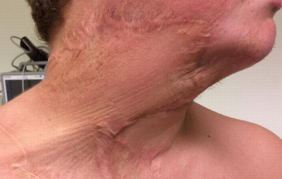 Burns, Scars & Contractures
